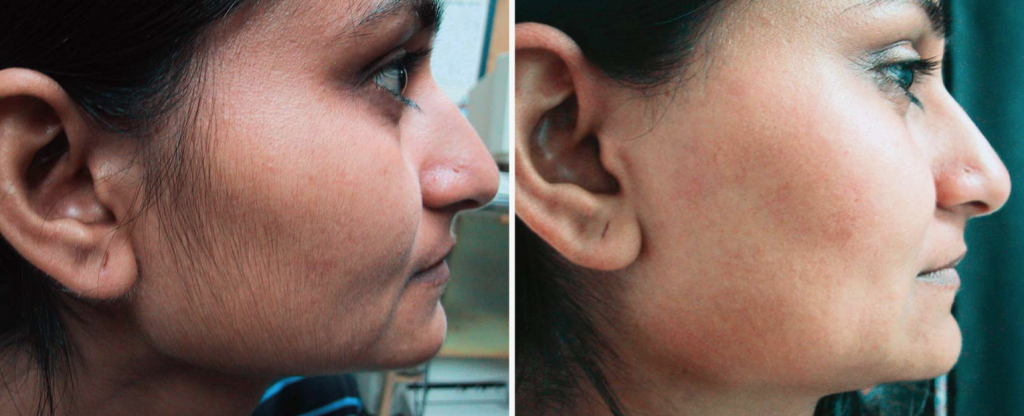 إزالة الشعر بالليزر - كل ما يتعلق بطرق التخلص من الشعر نهائيا 5 إزالة شعر الوجه بالليزر قبل وبعد
