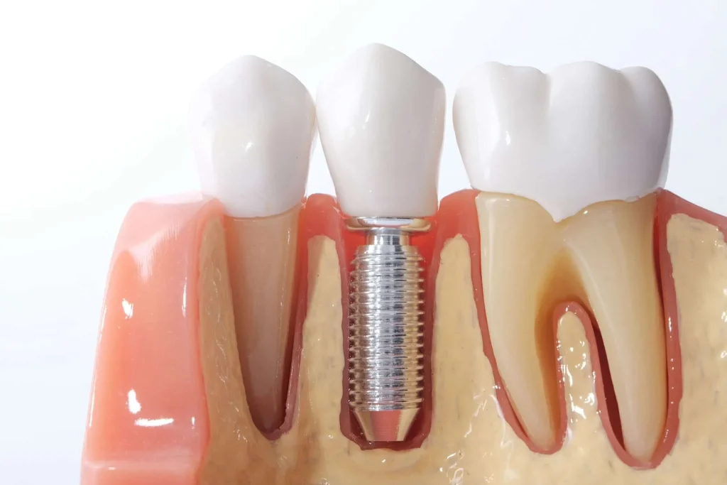 أنواع زراعة الأسنان وأسعارها في السعودية 1 الغرسات البطانية Endosteal implants